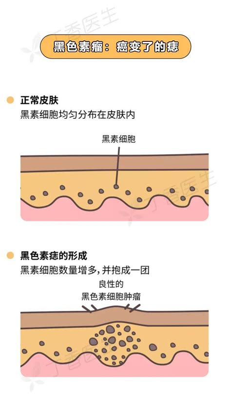 手掌痣|痣也可能会癌变！长在 3 个地方要注意